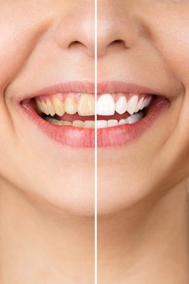 Smiling woman before and after the teeth whitening procedure, close-up image.