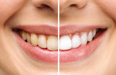 woman teeth before and after whitening. Over white background. Dental clinic patient. Image symbolizes oral care dentistry, stomatology.